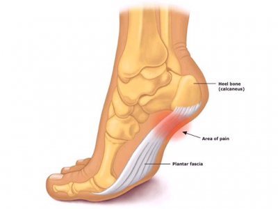 Fascia-plantar