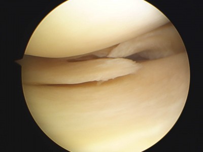 http://www.itstrauma.com/wp-content/uploads/Menisco-rotura-radial.jpg