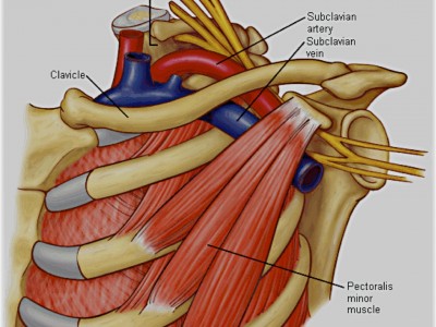 http://institutoneurocirugia.es/wp-content/uploads/Influencia-del-tend%C3%B3n-del-pectoral-menor-en-la-compresi%C3%B3n-del-paquete-v%C3%A1sculo-nervioso.jpg