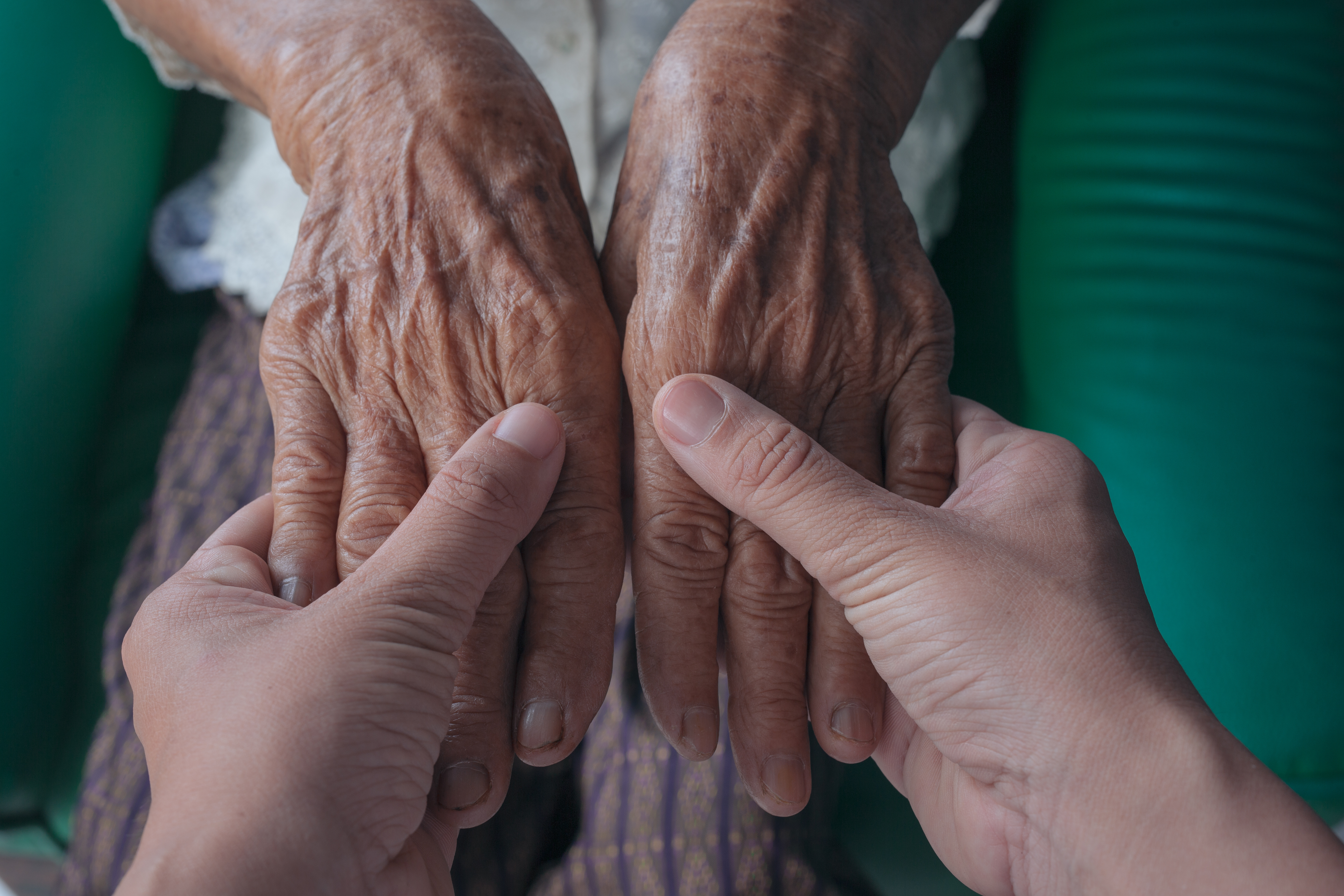 artritis reumatoide en manos